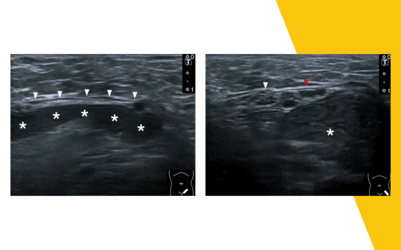 4. Hernia inguinal indirecta ecografia tempo formacion.png